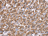 The image on the left is immunohistochemistry of paraffin-embedded Human thyroid cancer tissue using CSB-PA829093 (HSPE1 Antibody) at dilution 1/40, on the right is treated with synthetic peptide. (Original magnification: ×200)