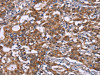 The image on the left is immunohistochemistry of paraffin-embedded Human gastric cancer tissue using CSB-PA557724 (HSPE1 Antibody) at dilution 1/40, on the right is treated with synthetic peptide. (Original magnification: ×200)