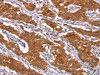 The image on the left is immunohistochemistry of paraffin-embedded Human gastric cancer tissue using CSB-PA780646 (HSPB6 Antibody) at dilution 1/40, on the right is treated with synthetic peptide. (Original magnification: ×200)