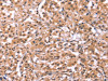 The image on the left is immunohistochemistry of paraffin-embedded Human thyroid cancer tissue using CSB-PA976207 (ID2 Antibody) at dilution 1/20, on the right is treated with synthetic peptide. (Original magnification: ×200)