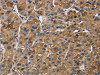 The image on the left is immunohistochemistry of paraffin-embedded Human liver cancer tissue using CSB-PA632749 (IGF2R Antibody) at dilution 1/50, on the right is treated with synthetic peptide. (Original magnification: ×200)