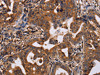 The image on the left is immunohistochemistry of paraffin-embedded Human gastic cancer tissue using CSB-PA944056 (IL12RB2 Antibody) at dilution 1/40, on the right is treated with synthetic peptide. (Original magnification: ×200)