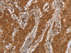 The image on the left is immunohistochemistry of paraffin-embedded Human gastic cancer tissue using CSB-PA032717 (IL17RA Antibody) at dilution 1/20, on the right is treated with synthetic peptide. (Original magnification: ×200)