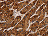 The image on the left is immunohistochemistry of paraffin-embedded Human liver cancer tissue using CSB-PA703502 (IL17RA Antibody) at dilution 1/40, on the right is treated with synthetic peptide. (Original magnification: ×200)