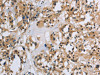 The image on the left is immunohistochemistry of paraffin-embedded Human thyroid cancer tissue using CSB-PA935849 (IL5RA Antibody) at dilution 1/40, on the right is treated with synthetic peptide. (Original magnification: ×200)