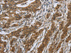 The image on the left is immunohistochemistry of paraffin-embedded Human gastric cancer tissue using CSB-PA547751 (IL5RA Antibody) at dilution 1/40, on the right is treated with synthetic peptide. (Original magnification: ×200)