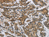 The image on the left is immunohistochemistry of paraffin-embedded Human colon cancer tissue using CSB-PA285442 (SYN1 Antibody) at dilution 1/50, on the right is treated with synthetic peptide. (Original magnification: ×200)