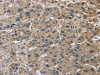 The image on the left is immunohistochemistry of paraffin-embedded Human liver cancer tissue using CSB-PA297207 (IMPDH1 Antibody) at dilution 1/20, on the right is treated with synthetic peptide. (Original magnification: ×200) The image on the left is immunohistochemistry of paraffin-embedded Human liver cancer tissue using CSB-PA297207 (IMPDH1 Antibody) at dilution 1/20, on the right is treated with synthetic peptide. (Original magnification: ×200)
