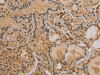 The image on the left is immunohistochemistry of paraffin-embedded Human thyroid cancer tissue using CSB-PA189944 (IPO9 Antibody) at dilution 1/40, on the right is treated with synthetic peptide. (Original magnification: ×200)