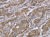 The image on the left is immunohistochemistry of paraffin-embedded Human gastric cancer tissue using CSB-PA598067 (IPO8 Antibody) at dilution 1/50, on the right is treated with synthetic peptide. (Original magnification: ×200)