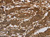 The image on the left is immunohistochemistry of paraffin-embedded Human gastic cancer tissue using CSB-PA939542 (ITGB7 Antibody) at dilution 1/30, on the right is treated with synthetic peptide. (Original magnification: ×200)