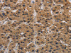 The image on the left is immunohistochemistry of paraffin-embedded Human liver cancer tissue using CSB-PA939542 (ITGB7 Antibody) at dilution 1/30, on the right is treated with synthetic peptide. (Original magnification: ×200)