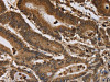 The image on the left is immunohistochemistry of paraffin-embedded Human colon cancer tissue using CSB-PA852295 (ITPR3 Antibody) at dilution 1/40, on the right is treated with synthetic peptide. (Original magnification: ×200)
