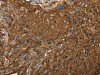 The image on the left is immunohistochemistry of paraffin-embedded Human esophagus cancer tissue using CSB-PA964497 (ITPR3 Antibody) at dilution 1/30, on the right is treated with synthetic peptide. (Original magnification: ×200)