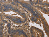 The image on the left is immunohistochemistry of paraffin-embedded Human colon cancer tissue using CSB-PA562372 (KCNG1 Antibody) at dilution 1/40, on the right is treated with synthetic peptide. (Original magnification: ×200)