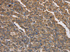 The image on the left is immunohistochemistry of paraffin-embedded Human liver cancer tissue using CSB-PA562372 (KCNG1 Antibody) at dilution 1/40, on the right is treated with synthetic peptide. (Original magnification: ×200)