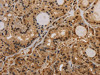 The image on the left is immunohistochemistry of paraffin-embedded Human thyroid cancer tissue using CSB-PA484256 (KCNN4 Antibody) at dilution 1/50, on the right is treated with synthetic peptide. (Original magnification: ×200)