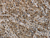 The image on the left is immunohistochemistry of paraffin-embedded Human liver cancer tissue using CSB-PA068103 (KIF4A Antibody) at dilution 1/40, on the right is treated with synthetic peptide. (Original magnification: ×200)