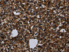 The image on the left is immunohistochemistry of paraffin-embedded Human prostate cancer tissue using CSB-PA791483 (KLK14 Antibody) at dilution 1/40, on the right is treated with synthetic peptide. (Original magnification: ×200)