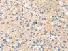 The image on the left is immunohistochemistry of paraffin-embedded Human liver cancer tissue using CSB-PA994603 (LPP Antibody) at dilution 1/30, on the right is treated with synthetic peptide. (Original magnification: ×200)