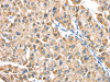 The image on the left is immunohistochemistry of paraffin-embedded Human liver cancer tissue using CSB-PA074212 (LTB4R2 Antibody) at dilution 1/20, on the right is treated with synthetic peptide. (Original magnification: ×200)