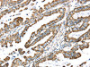 The image on the left is immunohistochemistry of paraffin-embedded Human esophagus cancer tissue using CSB-PA074212 (LTB4R2 Antibody) at dilution 1/20, on the right is treated with synthetic peptide. (Original magnification: ×200)