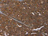 The image on the left is immunohistochemistry of paraffin-embedded Human ovarian cancer tissue using CSB-PA998557 (MCHR1 Antibody) at dilution 1/25, on the right is treated with synthetic peptide. (Original magnification: ×200)
