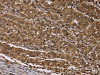 The image on the left is immunohistochemistry of paraffin-embedded Human liver cancer tissue using CSB-PA912611 (MEIS1 Antibody) at dilution 1/30, on the right is treated with synthetic peptide. (Original magnification: ×200)