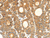 The image on the left is immunohistochemistry of paraffin-embedded Human thyroid cancer tissue using CSB-PA646965 (CYP7A1 Antibody) at dilution 1/30, on the right is treated with synthetic peptide. (Original magnification: ×200)