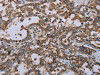 The image on the left is immunohistochemistry of paraffin-embedded Human liver cancer tissue using CSB-PA185762 (MMP23B Antibody) at dilution 1/20, on the right is treated with synthetic peptide. (Original magnification: ×200)