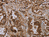 The image on the left is immunohistochemistry of paraffin-embedded Human liver cancer tissue using CSB-PA240239 (MOB1A Antibody) at dilution 1/20, on the right is treated with synthetic peptide. (Original magnification: ×200)