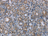 The image on the left is immunohistochemistry of paraffin-embedded Human thyroid cancer tissue using CSB-PA575736 (MTBP Antibody) at dilution 1/20, on the right is treated with synthetic peptide. (Original magnification: ×200)