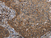The image on the left is immunohistochemistry of paraffin-embedded Human cervical cancer tissue using CSB-PA961786 (MT-ND6 Antibody) at dilution 1/40, on the right is treated with synthetic peptide. (Original magnification: ×200)