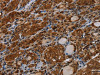 The image on the left is immunohistochemistry of paraffin-embedded Human thyroid cancer tissue using CSB-PA906238 (MYBBP1A Antibody) at dilution 1/40, on the right is treated with synthetic peptide. (Original magnification: ×200)