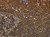 The image on the left is immunohistochemistry of paraffin-embedded Human cervical cancer tissue using CSB-PA014278 (MYBBP1A Antibody) at dilution 1/40, on the right is treated with synthetic peptide. (Original magnification: ×200)