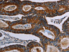 The image on the left is immunohistochemistry of paraffin-embedded Human colon cancer tissue using CSB-PA273795 (NDUFA4 Antibody) at dilution 1/40, on the right is treated with synthetic peptide. (Original magnification: ×200)