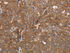 The image on the left is immunohistochemistry of paraffin-embedded Human ovarian cancer tissue using CSB-PA799827 (NDUFS2 Antibody) at dilution 1/50, on the right is treated with synthetic peptide. (Original magnification: ×200) The image on the left is immunohistochemistry of paraffin-embedded Human ovarian cancer tissue using CSB-PA799827 (NDUFS2 Antibody) at dilution 1/50, on the right is treated with synthetic peptide. (Original magnification: ×200)