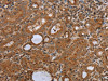 The image on the left is immunohistochemistry of paraffin-embedded Human thyroid cancer tissue using CSB-PA799827 (NDUFS2 Antibody) at dilution 1/50, on the right is treated with synthetic peptide. (Original magnification: ×200) The image on the left is immunohistochemistry of paraffin-embedded Human thyroid cancer tissue using CSB-PA799827 (NDUFS2 Antibody) at dilution 1/50, on the right is treated with synthetic peptide. (Original magnification: ×200)