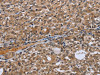 The image on the left is immunohistochemistry of paraffin-embedded Human thyroid cancer tissue using CSB-PA563181 (NRP2 Antibody) at dilution 1/35, on the right is treated with synthetic peptide. (Original magnification: ×200)