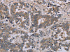 The image on the left is immunohistochemistry of paraffin-embedded Human liver cancer tissue using CSB-PA119051 (AATK Antibody) at dilution 1/45, on the right is treated with synthetic peptide. (Original magnification: ×200)