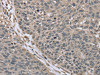 The image on the left is immunohistochemistry of paraffin-embedded Human lung cancer tissue using CSB-PA124825 (RHEB Antibody) at dilution 1/40, on the right is treated with synthetic peptide. (Original magnification: ×200)