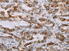 The image on the left is immunohistochemistry of paraffin-embedded Human liver cancer tissue using CSB-PA557232 (NMT1 Antibody) at dilution 1/45, on the right is treated with synthetic peptide. (Original magnification: ×200)