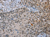 The image on the left is immunohistochemistry of paraffin-embedded Human cervical cancer tissue using CSB-PA557232 (NMT1 Antibody) at dilution 1/45, on the right is treated with synthetic peptide. (Original magnification: ×200)