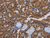 The image on the left is immunohistochemistry of paraffin-embedded Human thyroid cancer tissue using CSB-PA169583 (NPTX1 Antibody) at dilution 1/50, on the right is treated with synthetic peptide. (Original magnification: ×200)