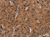 The image on the left is immunohistochemistry of paraffin-embedded Human liver cancer tissue using CSB-PA981790 (NRAS Antibody) at dilution 1/40, on the right is treated with synthetic peptide. (Original magnification: ×200)