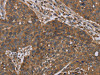 The image on the left is immunohistochemistry of paraffin-embedded Human lung cancer tissue using CSB-PA029863 (OXTR Antibody) at dilution 1/40, on the right is treated with synthetic peptide. (Original magnification: ×200)