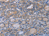 The image on the left is immunohistochemistry of paraffin-embedded Human thyroid cancer tissue using CSB-PA056352 (P2RX3 Antibody) at dilution 1/50, on the right is treated with synthetic peptide. (Original magnification: ×200)