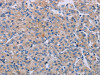 The image on the left is immunohistochemistry of paraffin-embedded Human prostate cancer tissue using CSB-PA056352 (P2RX3 Antibody) at dilution 1/50, on the right is treated with synthetic peptide. (Original magnification: ×200)