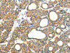 The image on the left is immunohistochemistry of paraffin-embedded Human thyroid cancer tissue using CSB-PA294107 (MMP9 Antibody) at dilution 1/20, on the right is treated with synthetic peptide. (Original magnification: ×200)