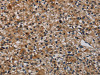 The image on the left is immunohistochemistry of paraffin-embedded Human prostate cancer tissue using CSB-PA052632 (TP53INP1 Antibody) at dilution 1/50, on the right is treated with synthetic peptide. (Original magnification: ×200)